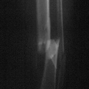 Radiografía de una pierna con una línea de fractura visible en la tibia