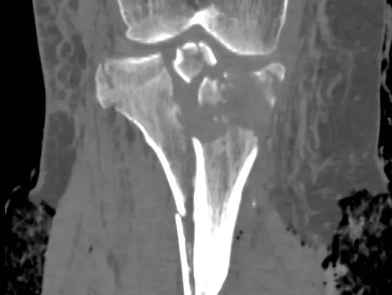 Tomografía computarizada de la rodilla y la parte alta de la tibia, que muestra el hueso en uno de sus cortes