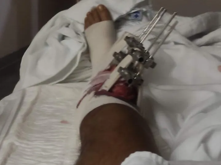 Mi pierna izquierda en la cama del hospital con el fijador externo recién colocado: las barras metálicas atraviesan la espinilla y la herida está vendada y con sangre.