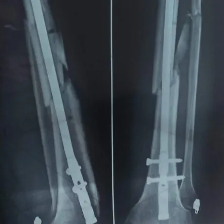 Radiografía de la tibia y el peroné en dos vistas después de la segunda cirugía: el clavo intramedular recorre la tibia y abajo se ven los tornillos de bloqueo.