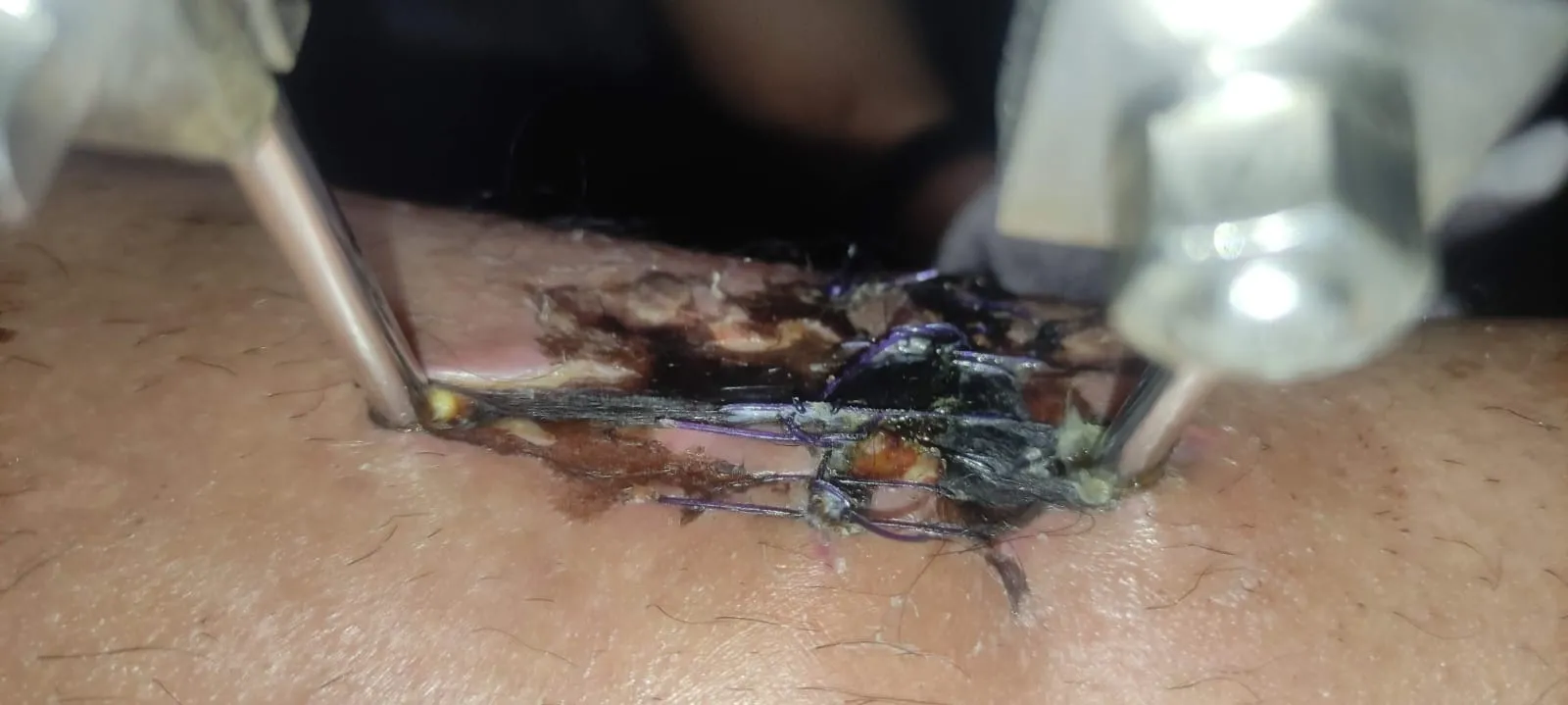 Acercamiento de la misma herida entre dos barras del fijador, con puntos y costra oscura.