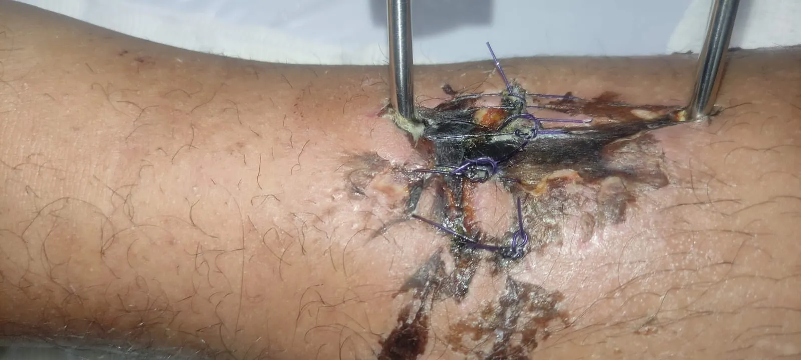La herida baja entre dos barras del fijador, con puntos y costras que se extienden hacia abajo.
