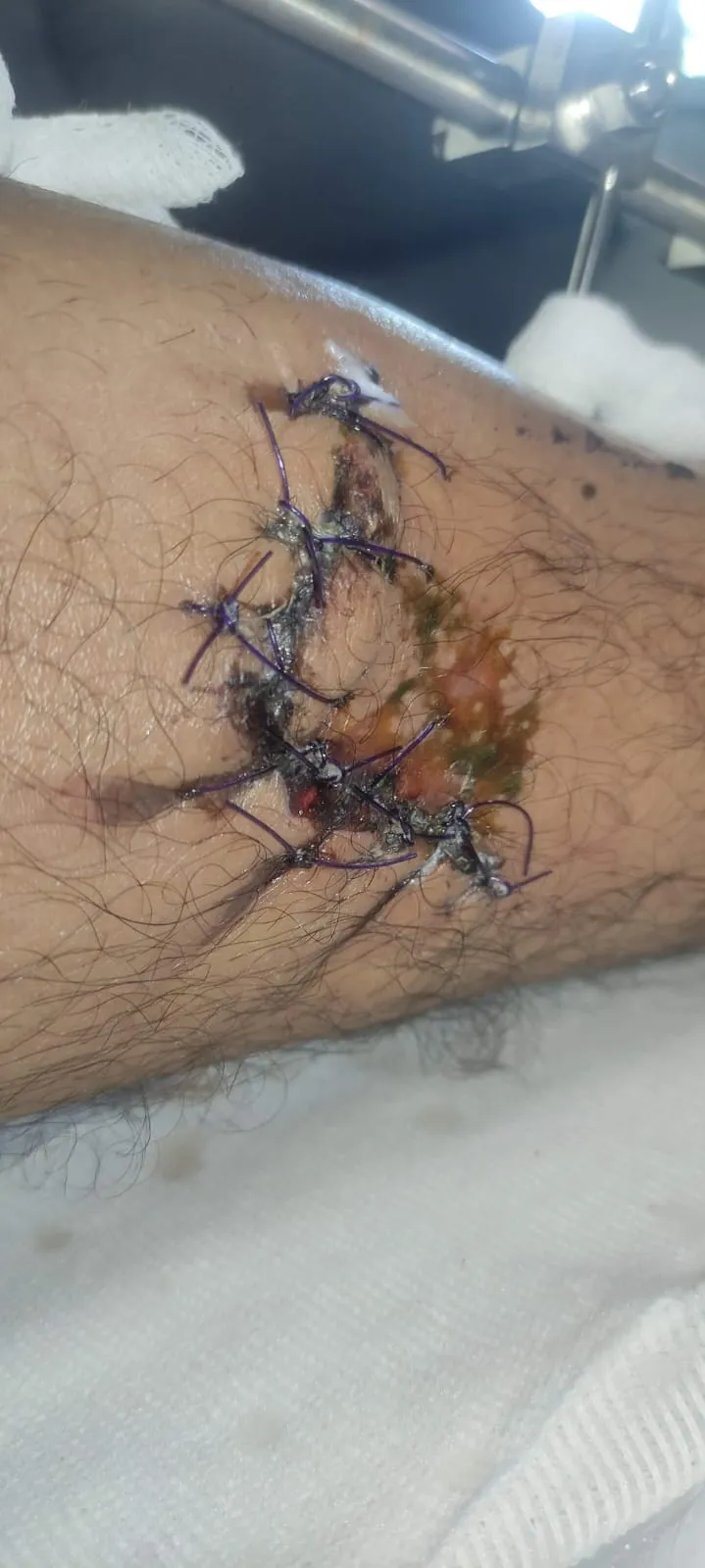 Herida suturada en la espinilla con una zona amarillenta de costra junto a los puntos.