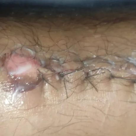 Cicatriz con puntos de la segunda cirugía, a la altura de la rodilla, por donde entró el clavo.