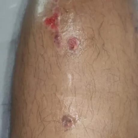 Marcas rojizas en la piel donde estaban las barras superiores del fijador externo.