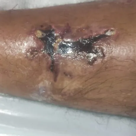 Zona oscura de piel necrosada, con costra, donde estaban las barras inferiores del fijador.