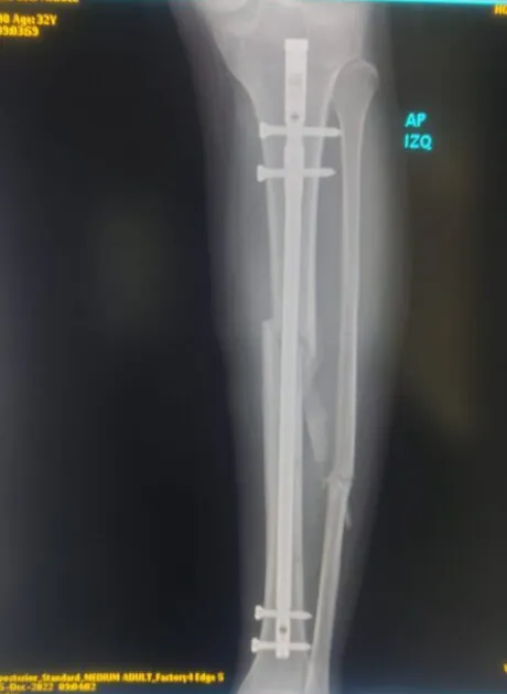 Radiografía de la tibia izquierda con el clavo intramedular colocado y los tornillos de bloqueo en cada extremo