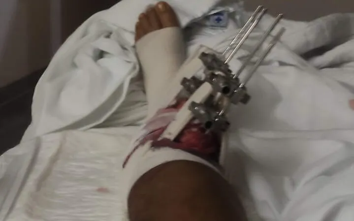 Pie vendado con un fijador externo colocado en la tibia; la piel alrededor de las varillas todavía tiene sangre y gasa