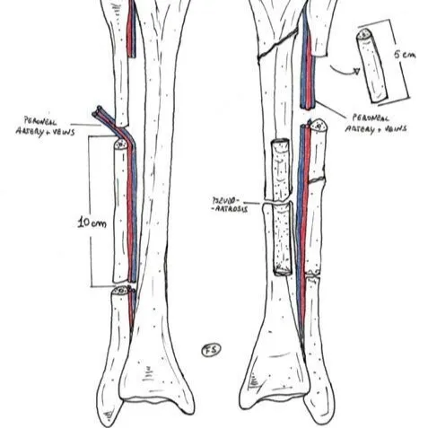 Diagrama de un injerto vascularizado de peroné: se toma un segmento de fíbula sana, con su arteria y su vena, para trasplantarlo al defecto de la tibia