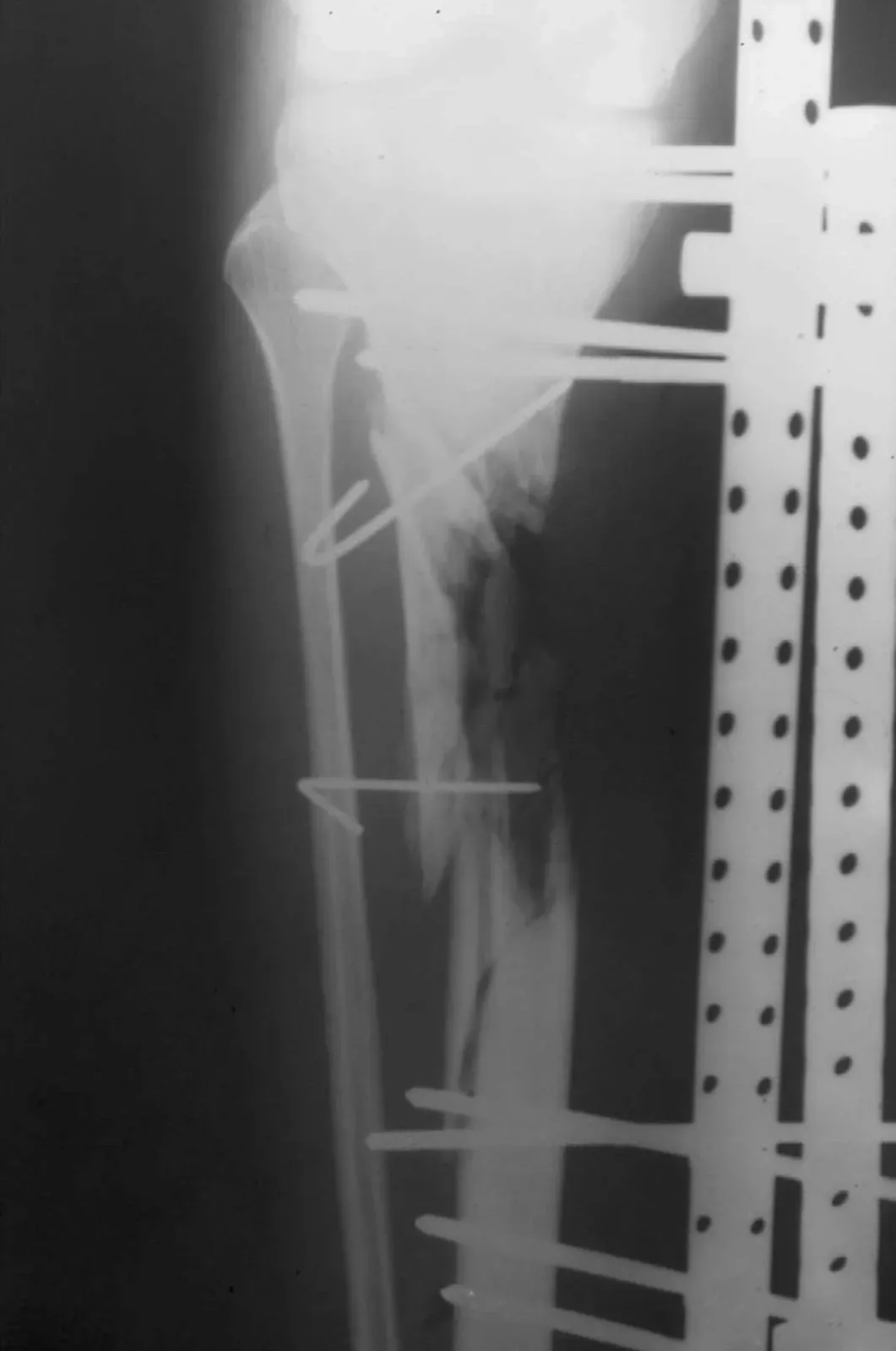 Radiografía de una tibia con fijador externo y un espacio vacío entre los dos fragmentos del hueso